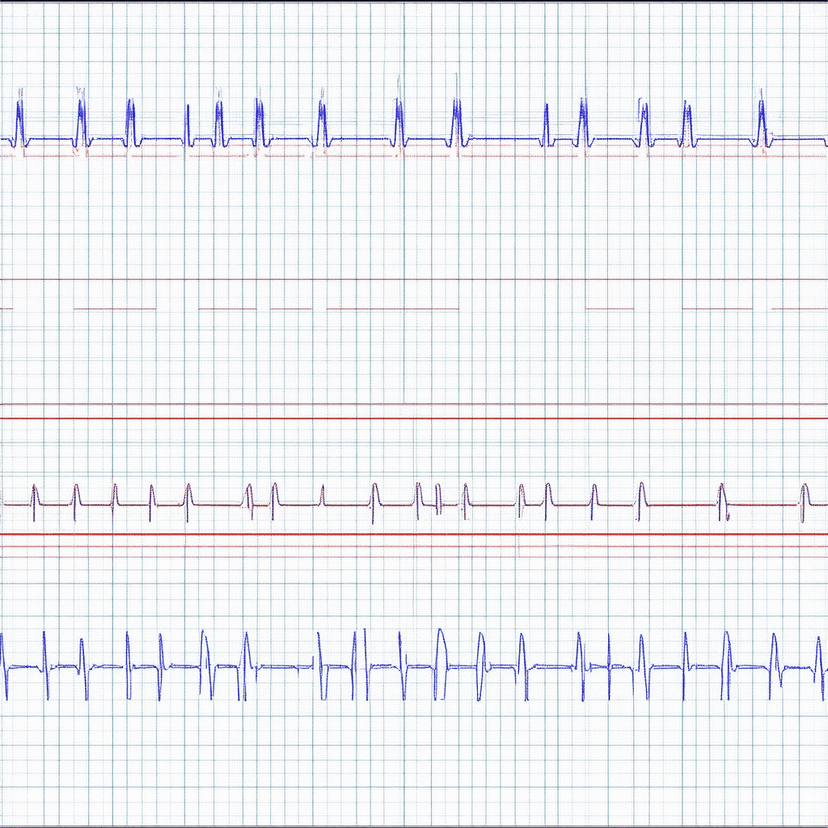 12-Lead ECG Reconstruction